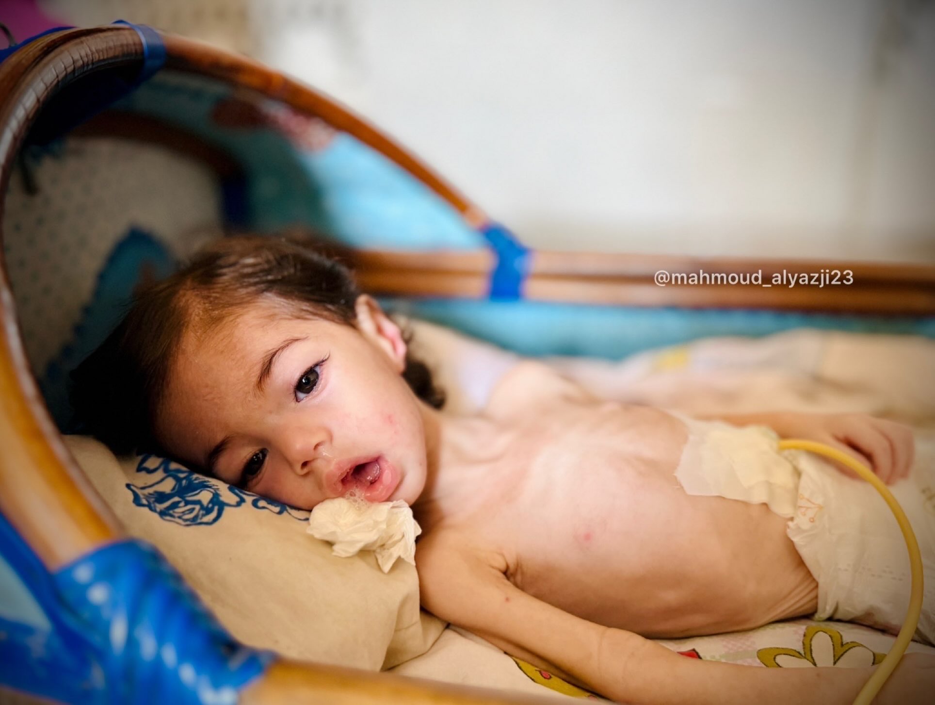 Mahmoud Faiq Al-Yazji’s life-threatening malnutrition in Gaza
