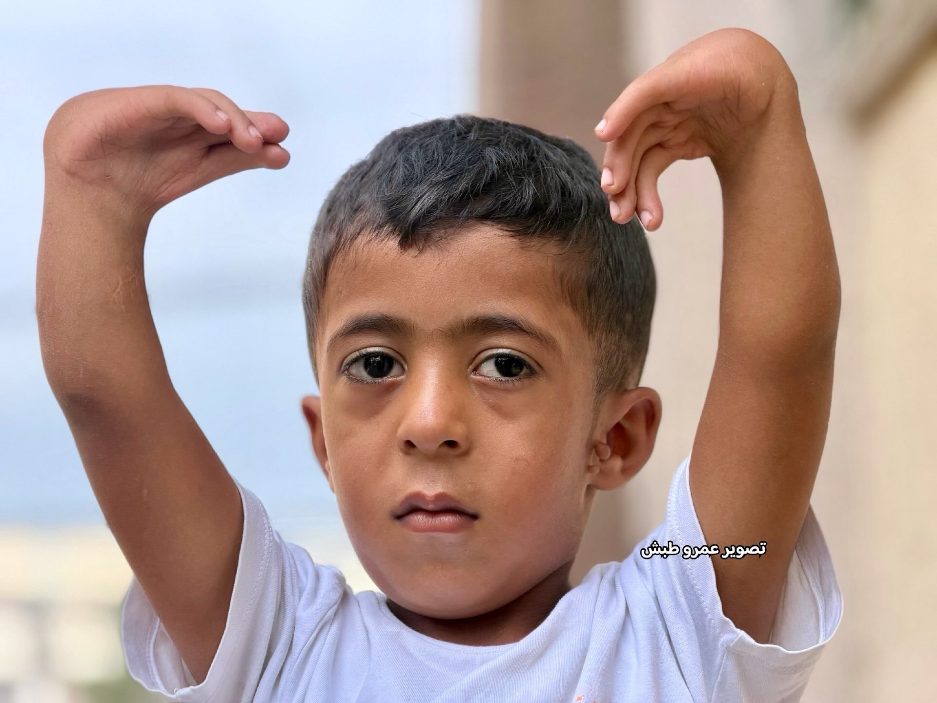 Gaza child with severe hand deformity needs surgery abroad