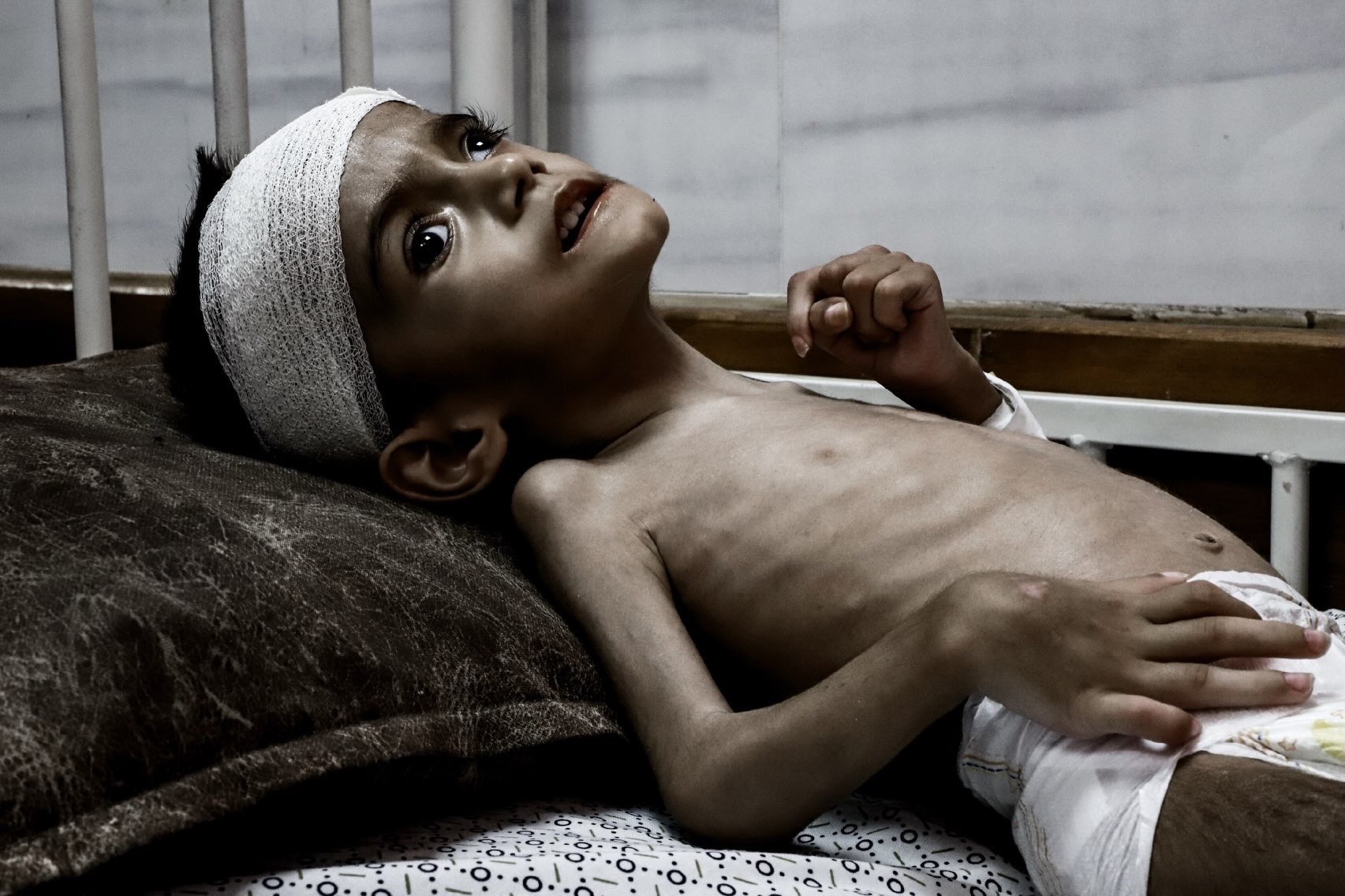 Three-year-old Yousef Basel Al-Adham suffers severe malnutrition in Gaza